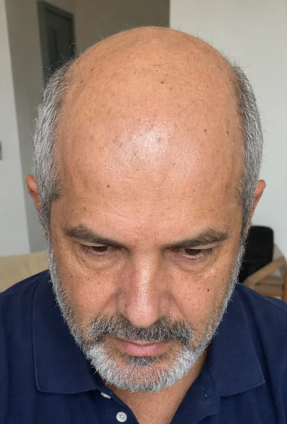 Luiz Lemos no início do acompanhamento, calvície avançada
